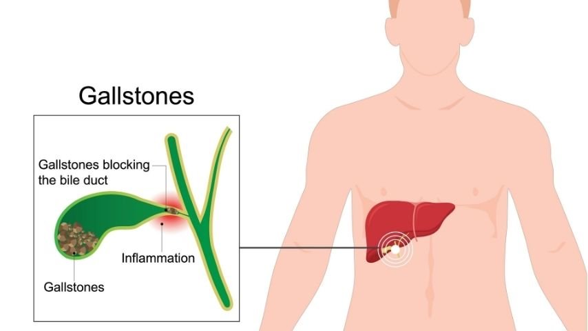 Can You Live With Gallstones Without Surgery-What Happens If You Keep Waiting
