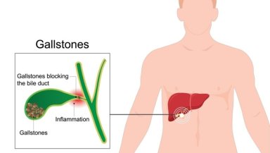 Can You Live With Gallstones Without Surgery-What Happens If You Keep Waiting Can You Live With Gallstones Without Surgery-What Happens If You Keep Waiting