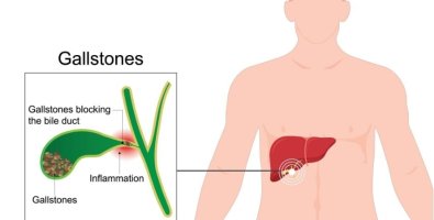 Can You Live With Gallstones Without Surgery-What Happens If You Keep Waiting Can You Live With Gallstones Without Surgery-What Happens If You Keep Waiting