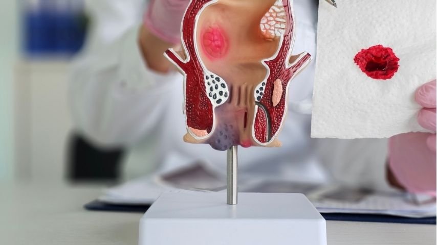 Rectal Bleeding, Pain or a Change in Bowel Habits- When Should You See a Colorectal Surgeon