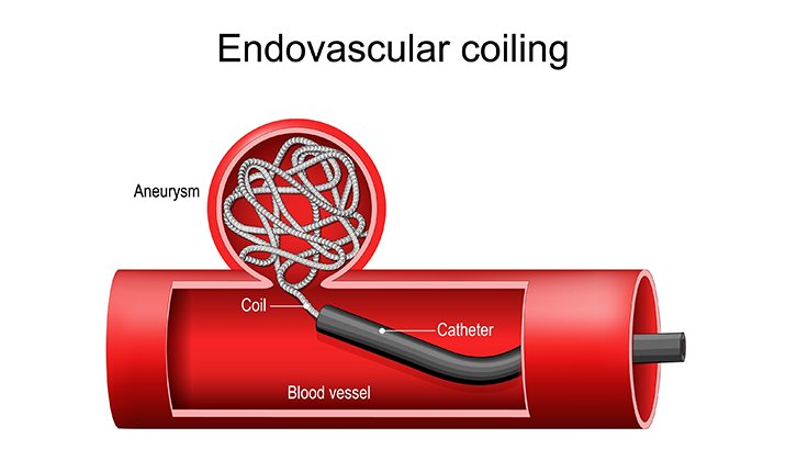 How a brain aneurysm is treated through endovascular coiling brain-aneurysm-endovascular-coiling
