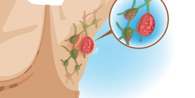 CT Scan Showing Enlarged Mediastinal Lymph Nodes- What It Could Mean CT Scan Showing Enlarged Mediastinal Lymph Nodes- What It Could Mean