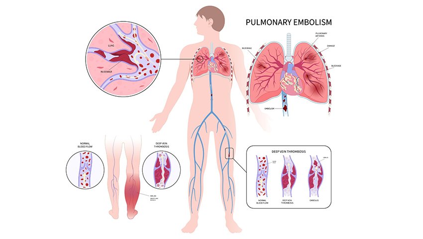 Choosing Between Thoracentesis and Other Pleural Effusion Treatments