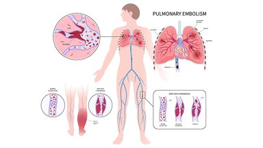 Choosing Between Thoracentesis and Other Pleural Effusion Treatments Choosing Between Thoracentesis and Other Pleural Effusion Treatments