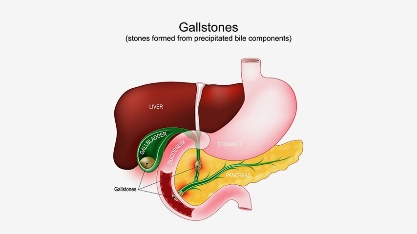 What Is Laparoscopic Cholecystectomy- A Clear Explanation for First-Timers