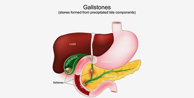 What Is Laparoscopic Cholecystectomy- A Clear Explanation for First-Timers What Is Laparoscopic Cholecystectomy- A Clear Explanation for First-Timers