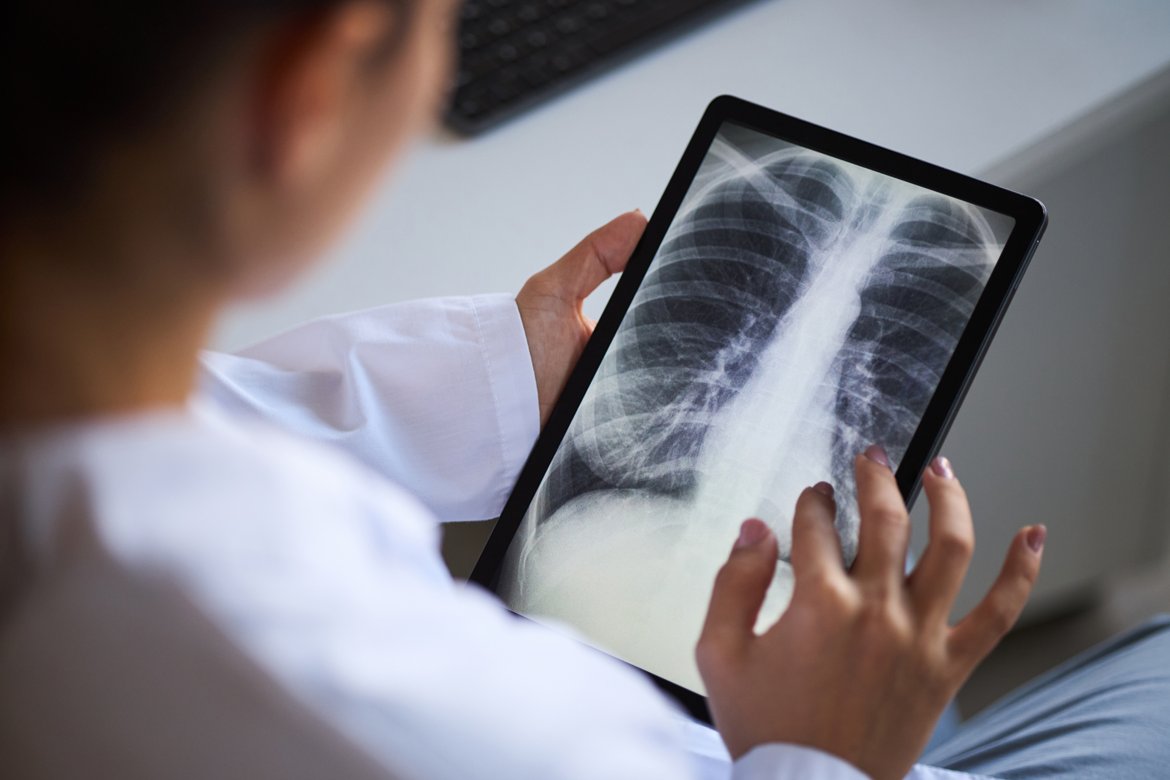 Tuberculosis: What to Know, Symptoms, Precautions, and Treatments