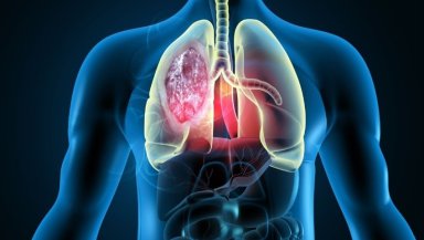 Why Do Lung Nodules or Shadows Lead to a Transbronchial Lung Biopsy Why Do Lung Nodules or Shadows Lead to a Transbronchial Lung Biopsy