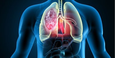 Why Do Lung Nodules or Shadows Lead to a Transbronchial Lung Biopsy Why Do Lung Nodules or Shadows Lead to a Transbronchial Lung Biopsy