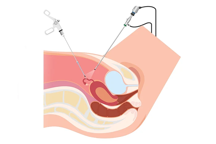 Laparoscopic Surgery