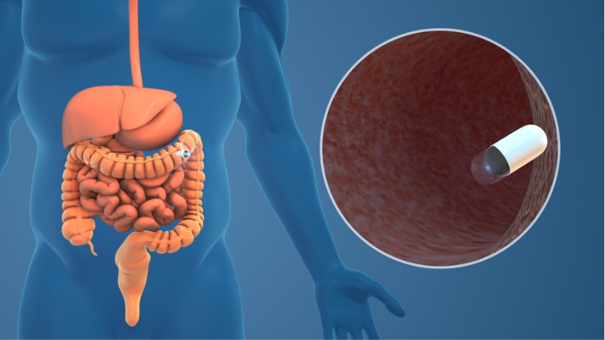 Capsule Endoscopy- A Tiny Camera with Big Answers