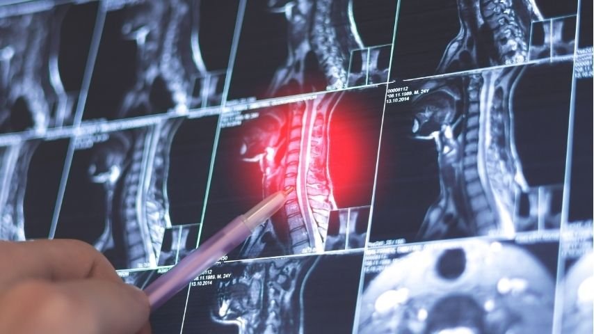 Slipped Disc, Herniated Disc, or Sciatica- What’s the Real Difference Slipped Disc, Herniated Disc, or Sciatica- What’s the Real Difference