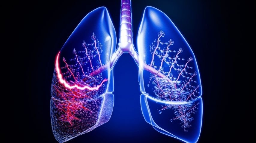 Bleeding or Lung Collapse