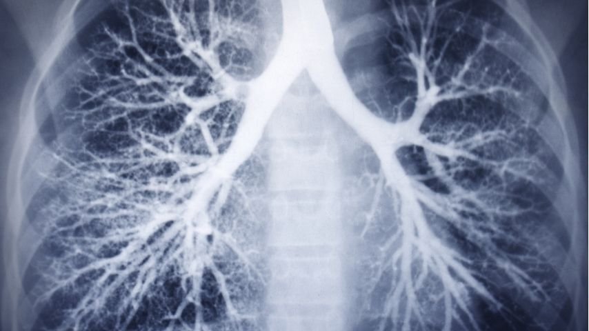 CT Scan Found a Lung Nodule Deep in the Lung- Why Doctors Use Navigation Bronchoscopy