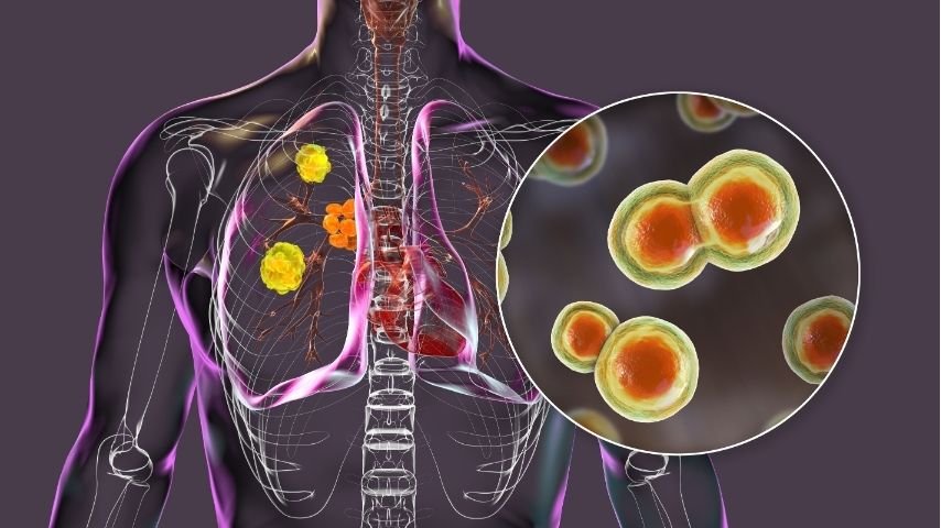 Peripheral Lung Nodules- Why Some Lung Spots Are Harder to Biopsy
