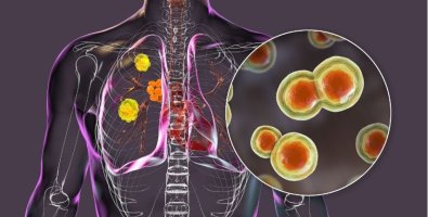 Peripheral Lung Nodules- Why Some Lung Spots Are Harder to Biopsy Peripheral Lung Nodules- Why Some Lung Spots Are Harder to Biopsy