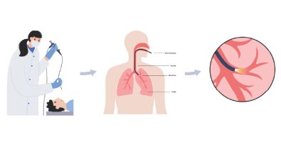 Why Doctors Use Bronchoscopy to Treat Airway Narrowing Instead of Open Surgery Why Doctors Use Bronchoscopy to Treat Airway Narrowing Instead of Open Surgery