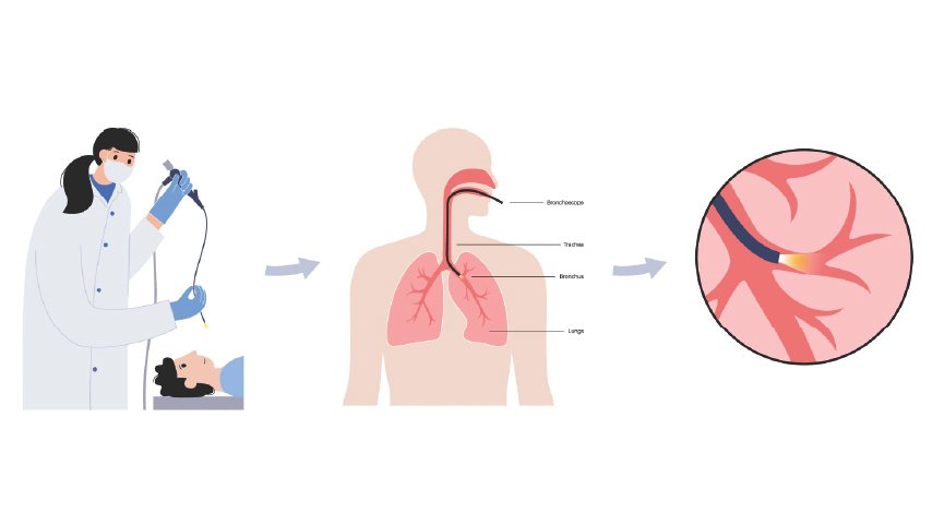 Why Doctors Use Bronchoscopy to Treat Airway Narrowing Instead of Open Surgery Why Doctors Use Bronchoscopy to Treat Airway Narrowing Instead of Open Surgery