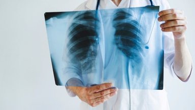 Should You Agree to a Transbronchial Lung Biopsy- Questions Patients Wish They Asked First Should You Agree to a Transbronchial Lung Biopsy- Questions Patients Wish They Asked First
