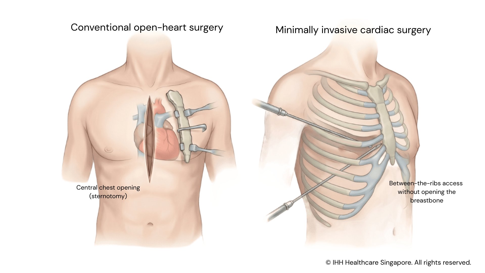 Conventional open heart vs MICS 1920x1080