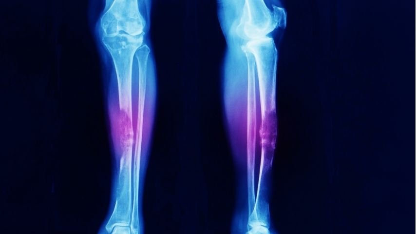 Soft Tissue vs Bone Sarcoma Surgery-What Patients Don’t Understand at Diagnosis Soft Tissue vs Bone Sarcoma Surgery-What Patients Don’t Understand at Diagnosis