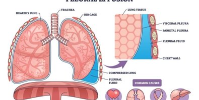 Pleural Effusion Explained-Why Fluid Keeps Coming Back and When Thoracoscopy Is Needed Pleural Effusion Explained-Why Fluid Keeps Coming Back and When Thoracoscopy Is Needed