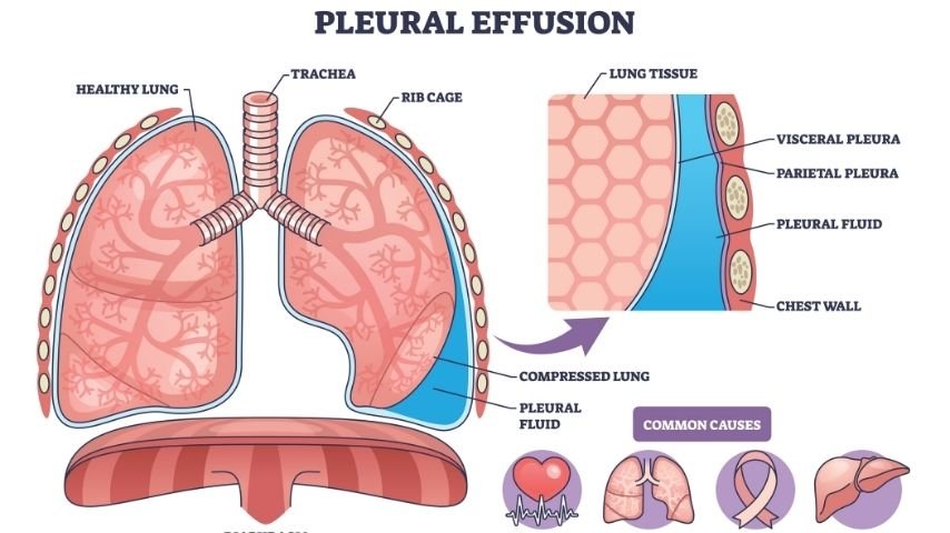 Pleural Effusion Explained-Why Fluid Keeps Coming Back and When Thoracoscopy Is Needed Pleural Effusion Explained-Why Fluid Keeps Coming Back and When Thoracoscopy Is Needed