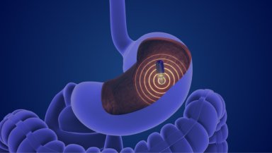 Can Capsule Endoscopy Detect Crohn's Disease When Colonoscopy Misses It Can Capsule Endoscopy Detect Crohn's Disease When Colonoscopy Misses It