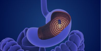 Can Capsule Endoscopy Detect Crohn's Disease When Colonoscopy Misses It Can Capsule Endoscopy Detect Crohn's Disease When Colonoscopy Misses It
