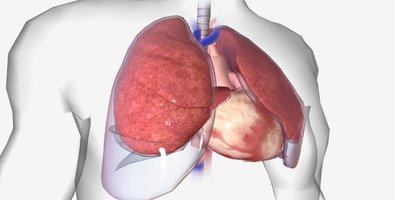 Understanding Medical Thoracoscopy- What It Is and Why Adhesiolysis Is Done Understanding Medical Thoracoscopy- What It Is and Why Adhesiolysis Is Done
