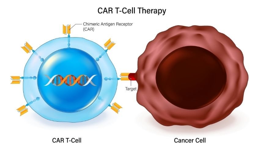 Cost, Access, and Where to Get CAR-T Therapy- A Practical Guide for Patients