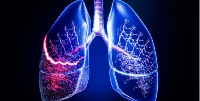 Lung Nodules Explained- Why Doctors Sometimes Recommend a Biopsy Lung Nodules Explained- Why Doctors Sometimes Recommend a Biopsy