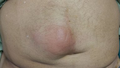 Is That Lump Really a Hernia-7 Signs You Shouldn't Ignore Is That Lump Really a Hernia-7 Signs You Shouldn't Ignore