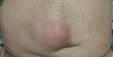 Is That Lump Really a Hernia-7 Signs You Shouldn't Ignore Is That Lump Really a Hernia-7 Signs You Shouldn't Ignore