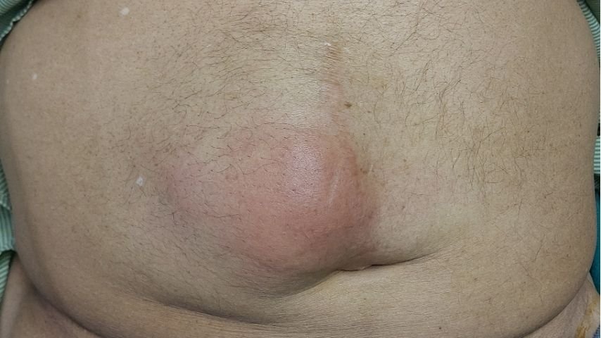 Is That Lump Really a Hernia-7 Signs You Shouldn't Ignore Is That Lump Really a Hernia-7 Signs You Shouldn't Ignore
