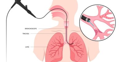 What Happens During Bronchoscopic Tracheal Stent Placement- A Step-by-Step Patient Guide What Happens During Bronchoscopic Tracheal Stent Placement- A Step-by-Step Patient Guide
