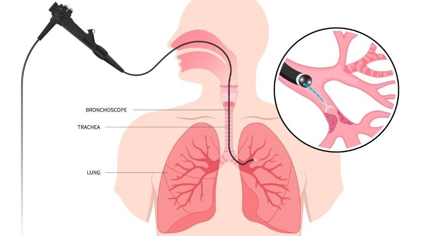 What Happens During Bronchoscopic Tracheal Stent Placement- A Step-by-Step Patient Guide What Happens During Bronchoscopic Tracheal Stent Placement- A Step-by-Step Patient Guide