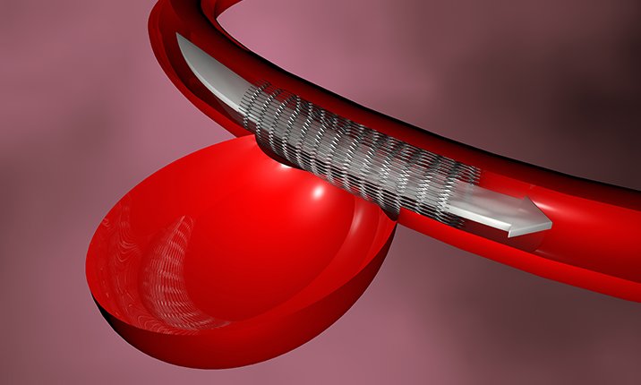 How a brain aneurysm is treated using a flow diverter brain-aneurysm-flow-diversion