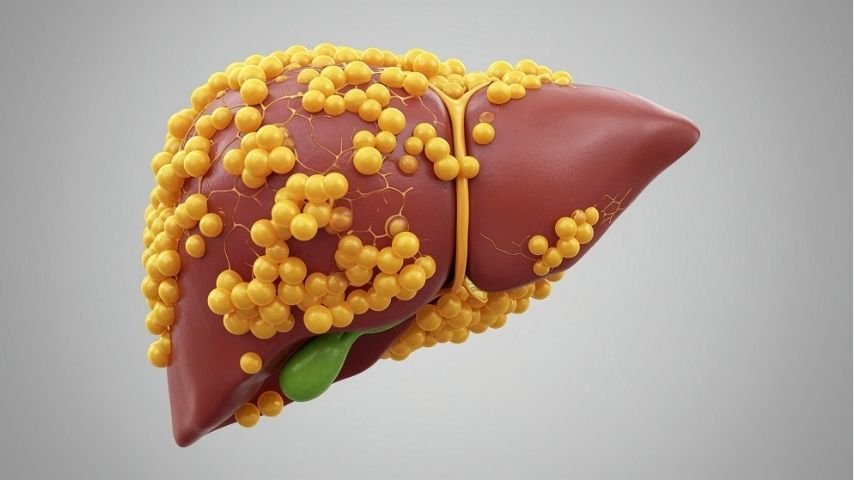 Fatty Liver