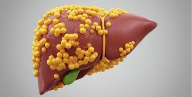 Fatty Liver Fatty Liver