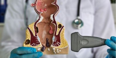 Is Laser Fistula Surgery Really Successful-What Patients Should Know About Healing, Failure and Recurrence Rates Is Laser Fistula Surgery Really Successful-What Patients Should Know About Healing, Failure and Recurrence Rates