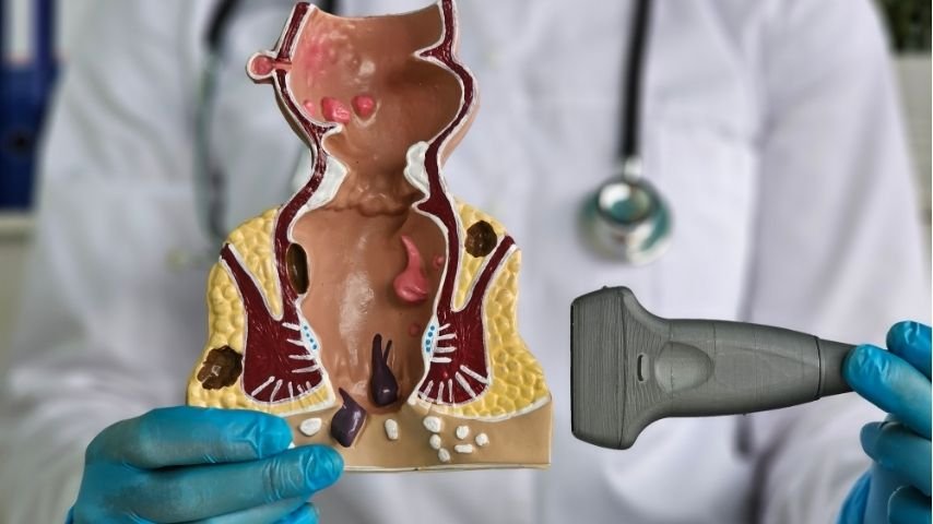 Is Laser Fistula Surgery Really Successful-What Patients Should Know About Healing, Failure and Recurrence Rates Is Laser Fistula Surgery Really Successful-What Patients Should Know About Healing, Failure and Recurrence Rates