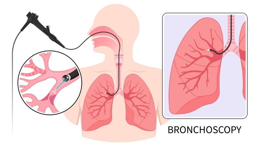 Bronchoscopy vs EBUS- What&rsquo;s the Difference Between These Lung Tests