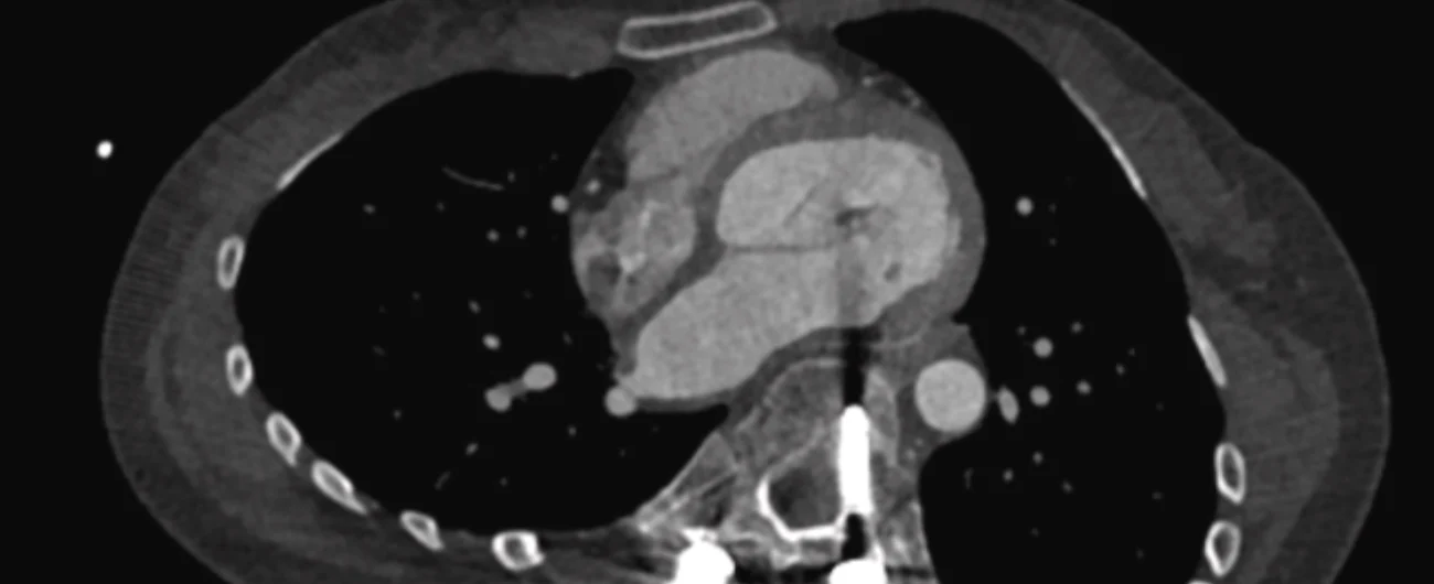 ultrasound of heart