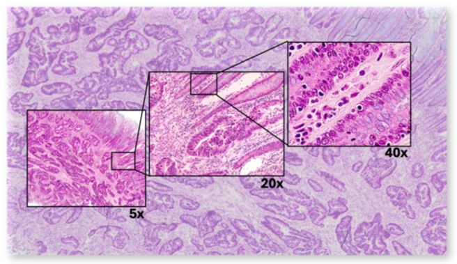 Image analysis performed by Natalia Dworak at the Spatial Biology Core. Colon Cancer.